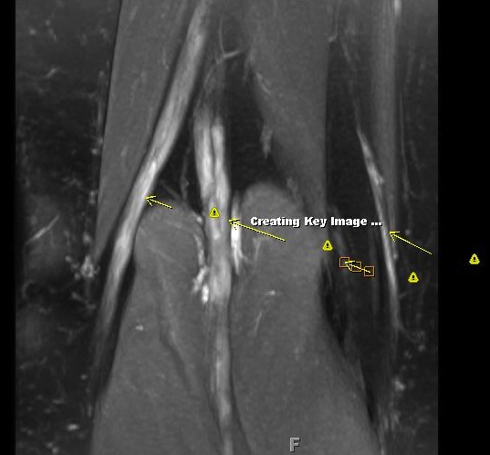 Figure 4 for case Charcot Marie Tooth Type 1a